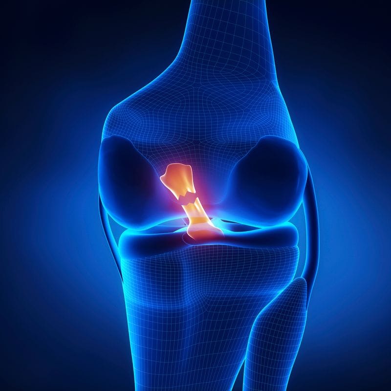 Identifying and Rehabbing an Anterior Cruciate Ligament Injury